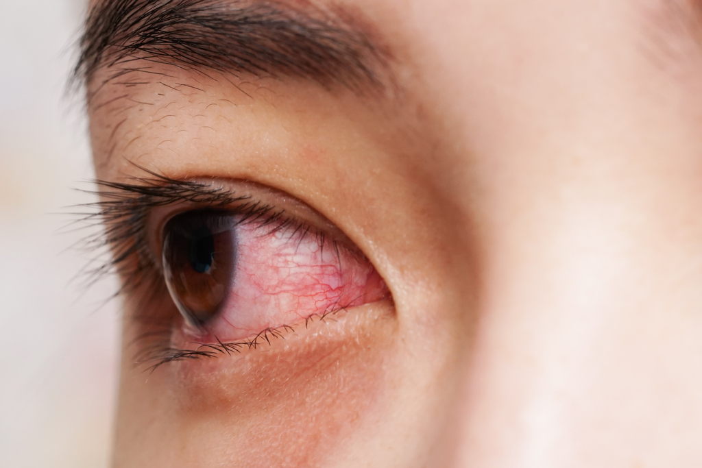 Eye Redness Infection treatment